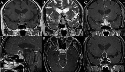 Adult Sellar Region Atypical Teratoid/Rhabdoid Tumor: A Retrospective Study and Literature Review